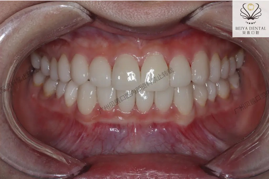 Real Patient Results: Veneers & Full-Mouth Implants in Guangzhou